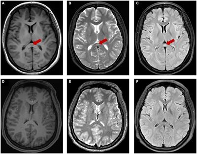 Transient splenial lesion syndrome in bipolar-II disorder: a case report highlighting reversible brain changes during hypomanic episodes